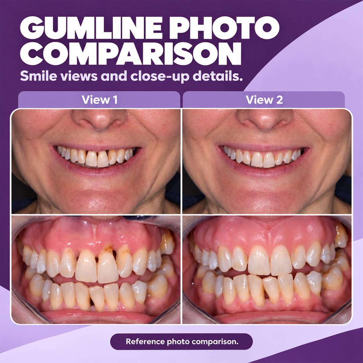 Marine Collagen for Gums — Supports Healthy Gingival Tissue