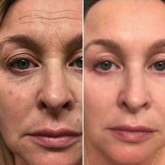 Customer before and after skincare results